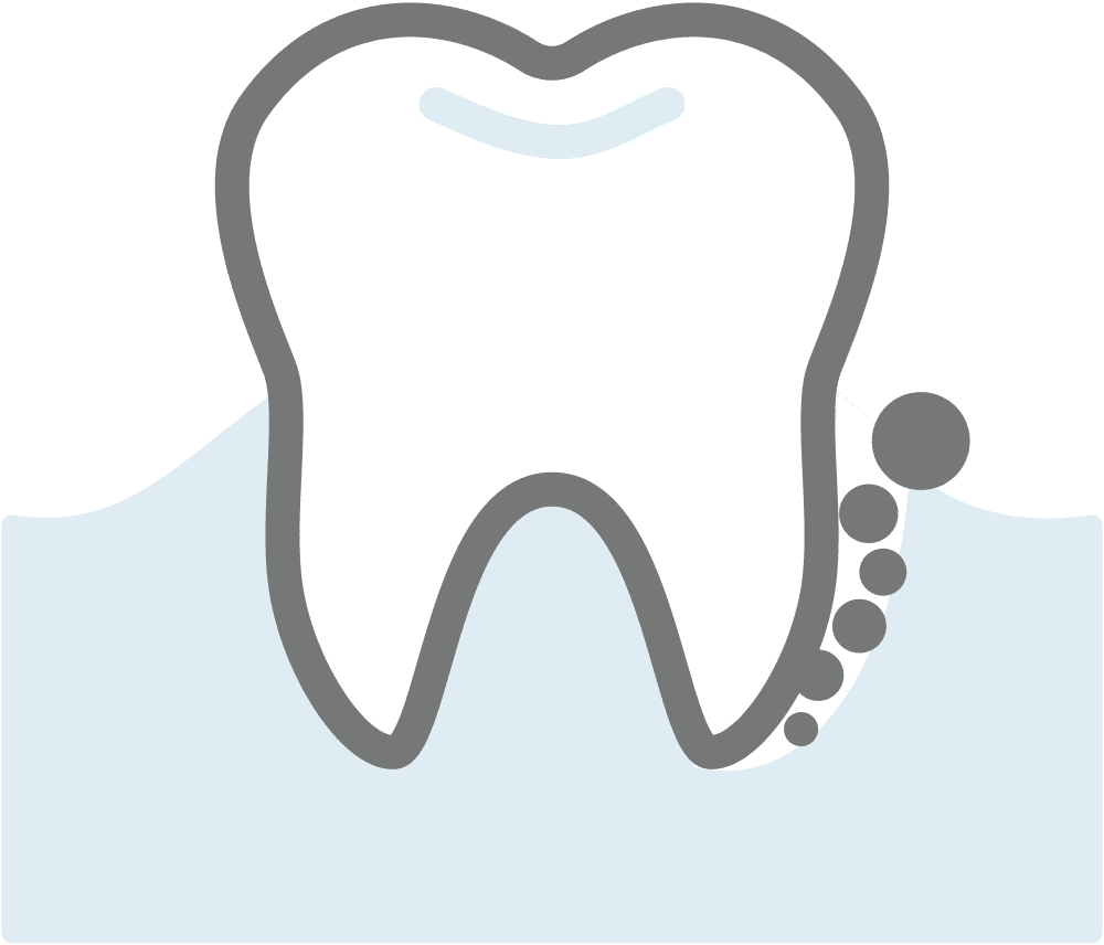 イラスト：歯周ポケットに溜まる歯垢のイメージ