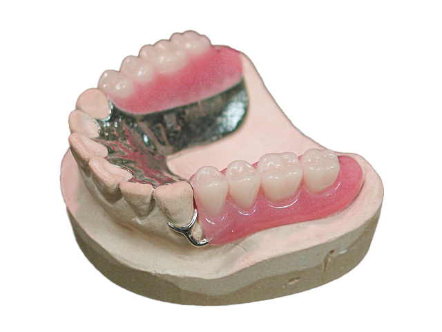 金属床の義歯・入れ歯
